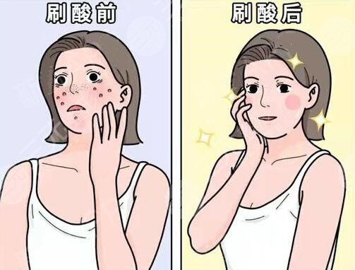 果酸祛痘