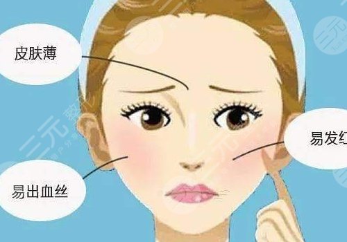 红血丝皮肤用什么护肤品?3