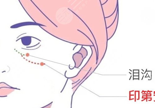 泪沟与眼袋的区别图