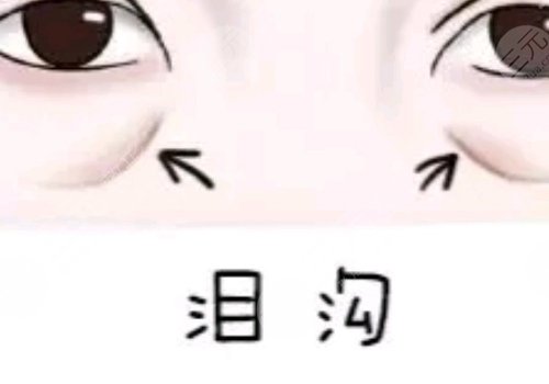 泪沟与眼袋的区别图