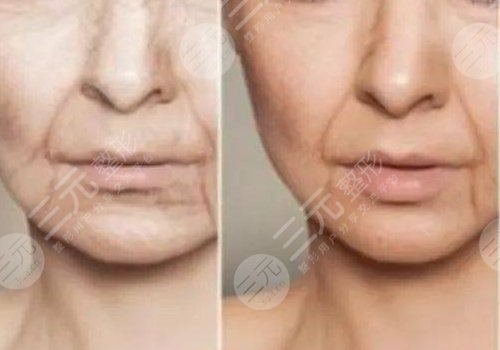 木偶纹医美怎么消除?注射玻尿酸,超声刀,脂肪填充各优势盘点!