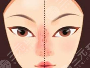鼻整形