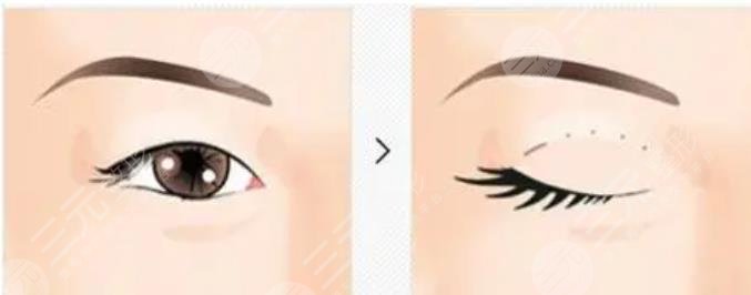 双眼皮
