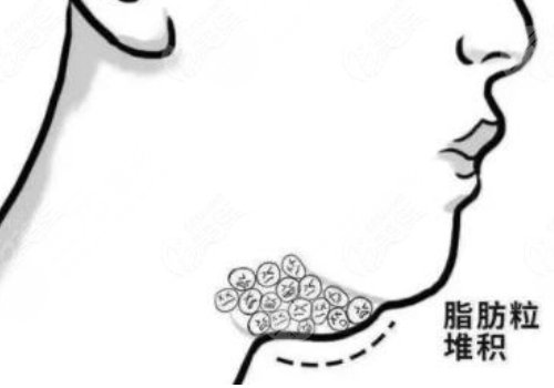 超声炮下颌缘有必要做吗？