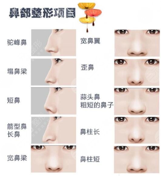 隆鼻整形手术
