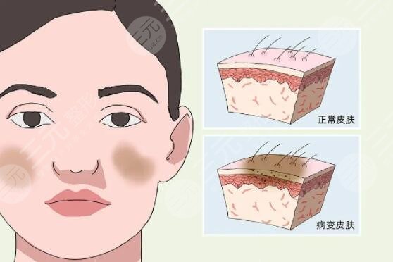 激光去除黄褐斑