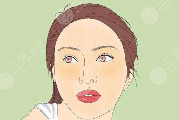 微针去除黄褐斑