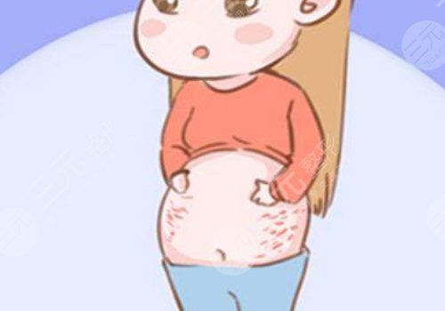 如何消除妊娠纹?