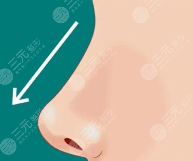 隆鼻整形手术