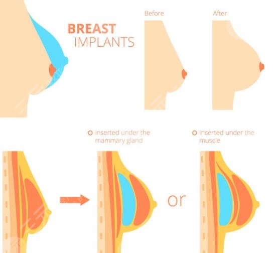 伊思雅假体的效果怎么样?