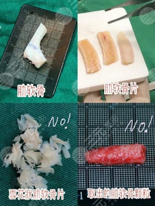 自体软骨隆鼻的优势