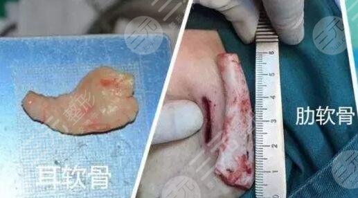 自体软骨隆鼻的注意事项