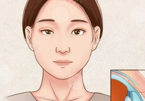 杨连华医生双眼皮案例