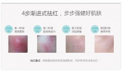 彩光缓解红血丝要做多少次才能好？科普解答，医美小知识！