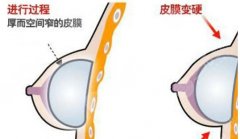 复合隆胸会包膜挛缩吗？术前常识扫盲！美胸必修课~