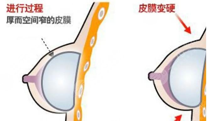 包膜挛缩