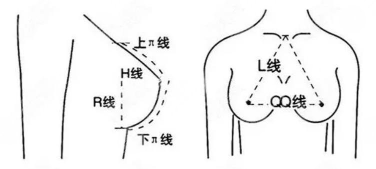 隆胸