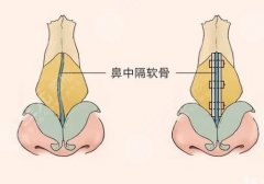 #网友投稿#杭州星光丽格医美做鼻子案例:鼻型立体流畅,后悔没早去~ #网友投稿#杭州星光丽格医美做鼻子案例:鼻型立体流畅,后悔没早去~