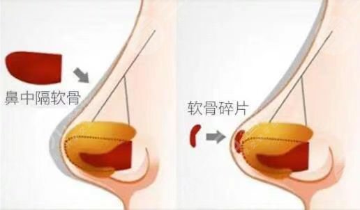杭州星光丽格医美做鼻子案例