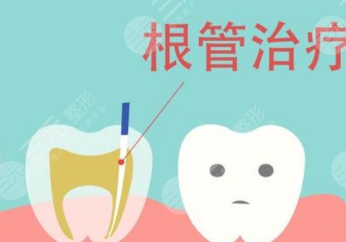 根管缓解一颗全部费用