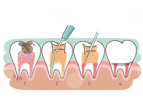 根管缓解一颗全部费用