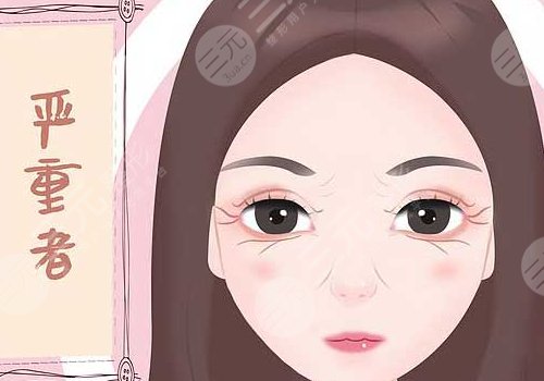 去鱼尾纹手术多少钱呢？