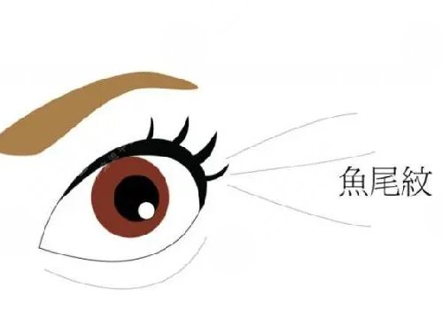 鱼尾纹手术哪种好？