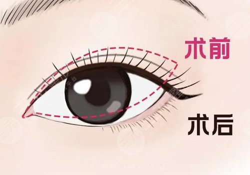 开眼角疼不疼呢？效果如何？