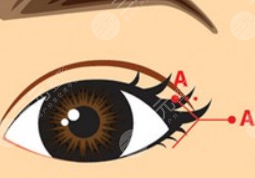 开眼角疼不疼呢？效果如何？