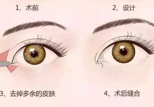 开眼角疼不疼呢？效果如何？