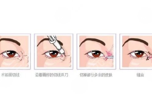 开眼角疼不疼呢？效果如何？