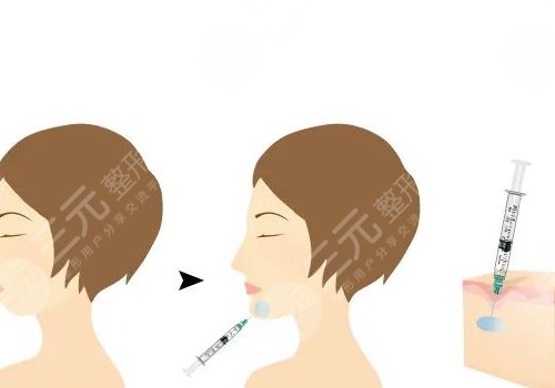 自体脂肪隆下巴多少钱？