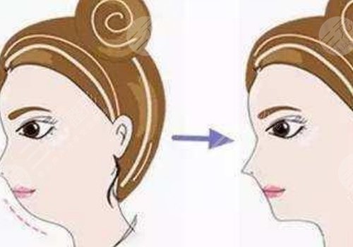 自体脂肪隆下巴多少钱？