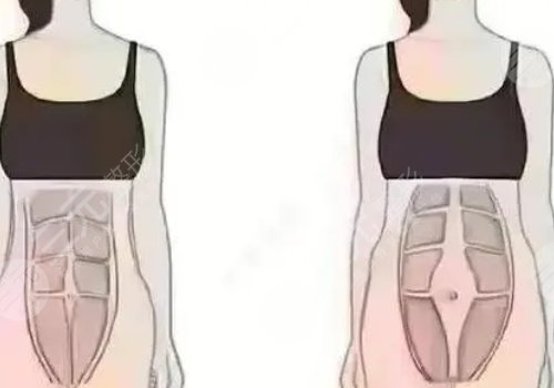 腹壁成型属于几类手术?
