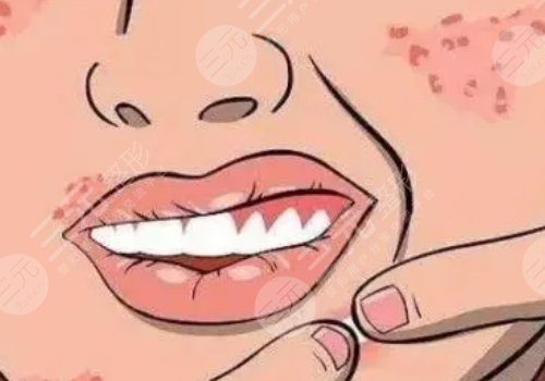 痤疮缓解需要多少费用?