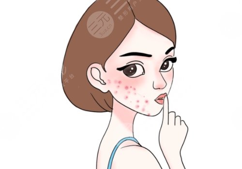 痤疮缓解需要多少费用?