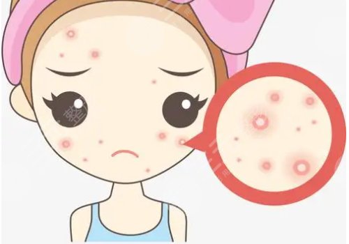 痤疮缓解需要多少费用?