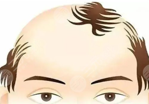 额头头发稀少怎么办?