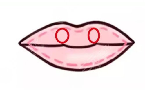 厚唇改薄能维持多久