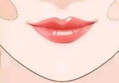 厚唇改薄能维持多久