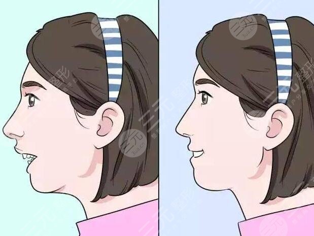 暴牙矫正的方式以及相应价格