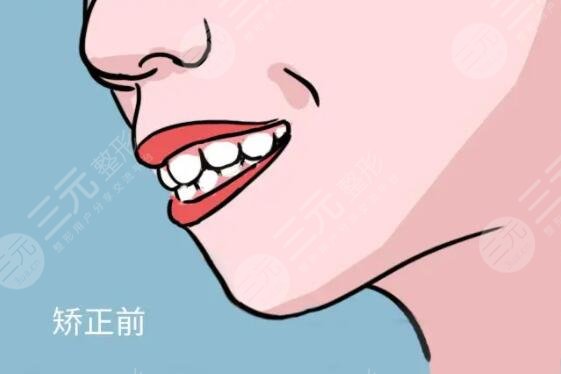影响暴牙矫正价格的因素