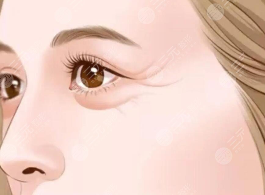 怎样防止鱼尾纹的出现？出现鱼尾纹后应该怎么保养？