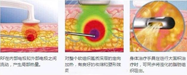 光纤溶脂好不好?