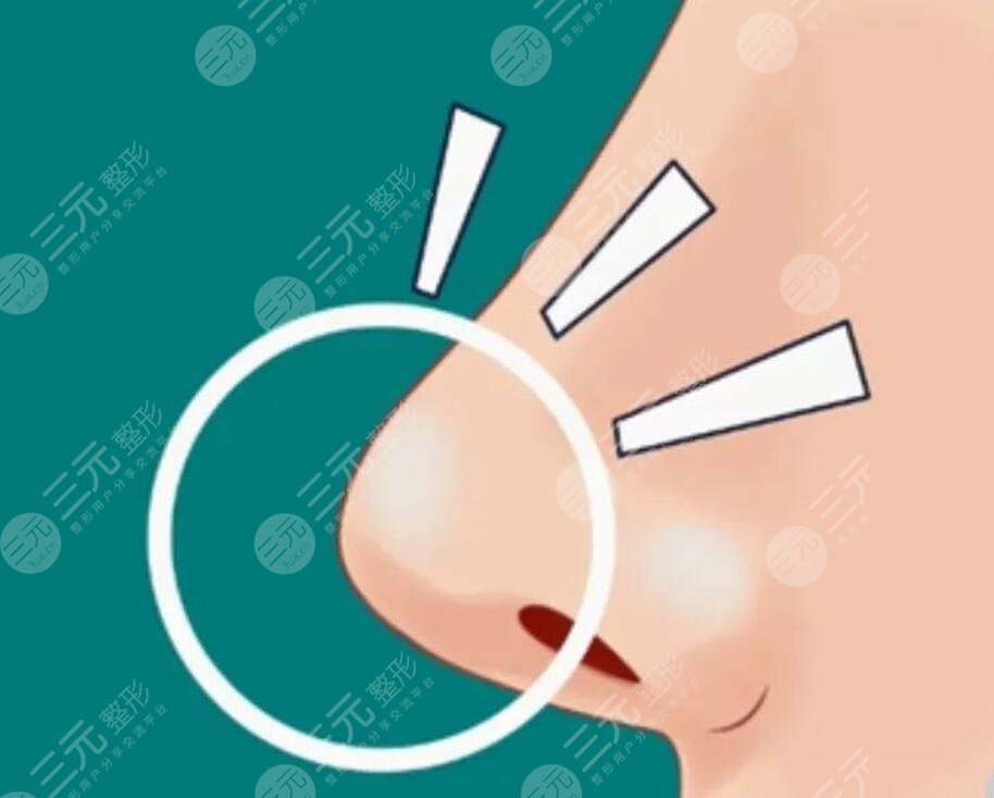 垫鼻梁后遗症一