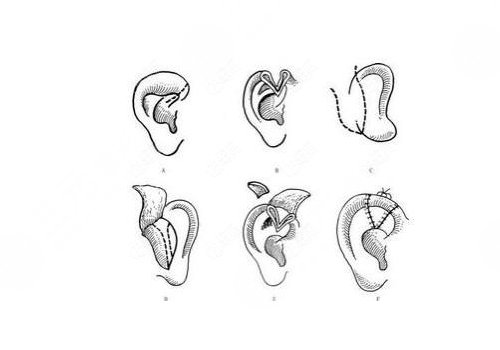 全耳再造手术费用多少钱？