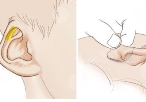 全耳再造手术费用多少钱？