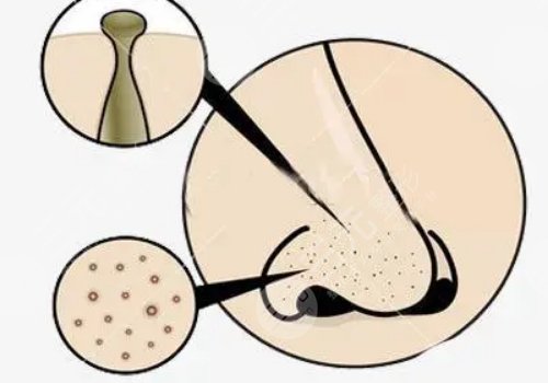 男性毛孔粗大油腻怎么改良？