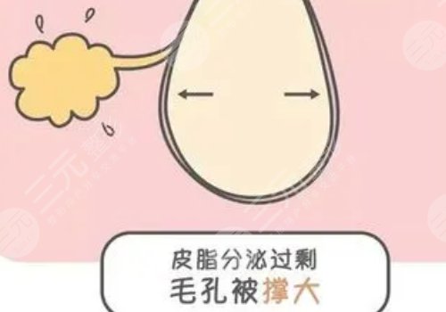 男性毛孔粗大油腻怎么改良？