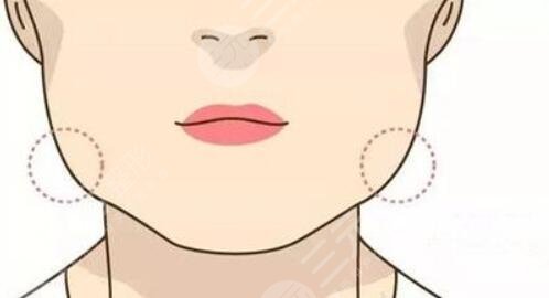 下颌角肥大怎么处理？有效的改良方式汇总，你适合哪种？